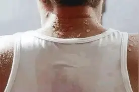 动不动就出汗究竟是怎么回事？可能提示哪些疾病视频封面