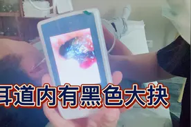耳道内有黑色大抉耳屎视频封面