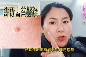 苏北媳妇亲测有效，无花果白色汁轻松去除各种疣，具体用法分享