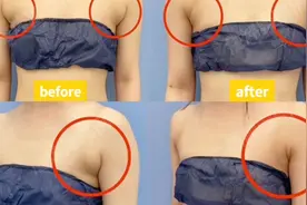 副乳吸脂3个月，她说可以实现穿衣自由了！视频封面