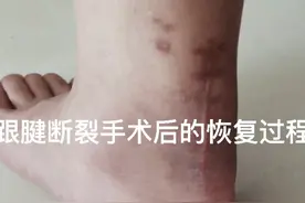 跟腱断裂手术后的恢复过程，60天基本可以正常行走了！视频封面
