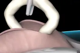 男性女性结扎全过程，真的不痛苦吗？视频封面