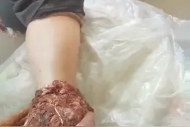 秘方㊙️快速接骨