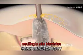 医学3D视频系列10:“痤疮”痘痘的形成过程