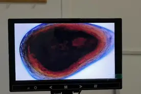 前列腺结石能排出来吗？浙江前列腺炎病友理疗后排出四块大结石。视频封面