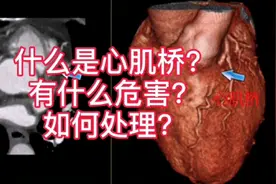 什么是心肌桥？有什么危害？如何处理？