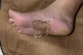 人体的脚底有很多穴位经过中药药酒七天外敷以后脚底的死皮开始了视频封面
