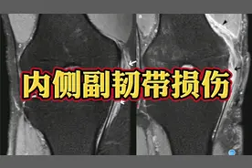 膝关节内侧副韧带损伤MRI上什么表现？如何分级？视频封面