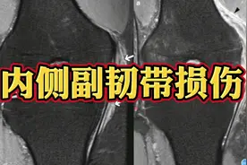 膝关节内侧副韧带损伤MRI上什么表现？如何分级？视频封面