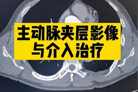 最凶险疾病—主动脉夹层影像表现与介入治疗，胸痛三联征，危急值视频封面