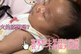 宝宝脸上手臂长了个超级大痘痘，是上火引起的？还是想出水痘？