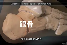 足跟跟骨骨折手术修复过程，3D演示。。