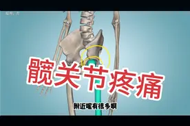 推拿必备知识，髋关节疼痛，3种常见原因，带你了解一下。视频封面