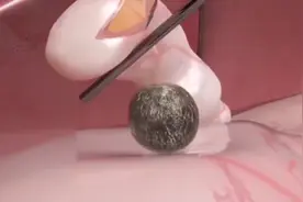 腹腔镜胆囊结石切除术手术过程，3D演示。。