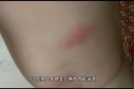 如何判断身上的疙瘩或者红点是不是螨虫叮咬导致的视频封面