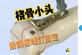 桡骨小头骨折用钢板螺钉内固定视频封面