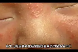 盘点20种常见的新生儿皮肤表现#希望能帮到有需要的人视频封面