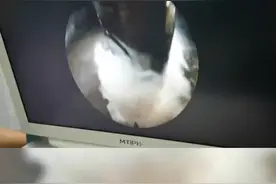 腰椎间盘突出微创取髓核视频封面