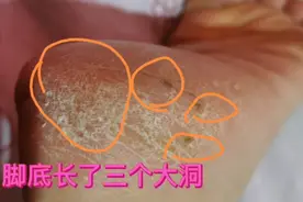 脚底长了三个大洞，十年未见好转，都说是皮肤癌不要命的，别吓我视频封面