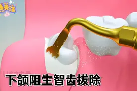 下颌阻生智齿拔除，3D动画演示，超声骨刀拔智齿