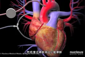 让心脏停跳，做心脏主动脉瓣置换术手术过程，3D演示。。视频封面