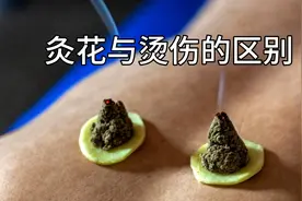 艾灸时灸花与烫伤的区别，以及处理方法
