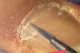 俄式前处理：指甲两侧硬皮终于有救星了！视频封面