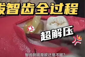 解压视频！拔智齿全过程，只是看看就感受到了酸爽~超解压视频封面