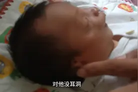 小婴儿耳朵畸形，带你们近距离看吧，好多人发信息说叫我扒拉开。视频封面
