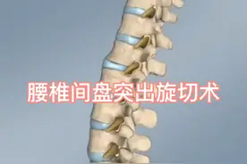 腰椎间盘突出症旋切手术治疗演示，比传统手术更微创！视频封面