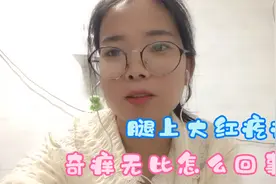 小杰腿上起了好多可大又可痒红疙瘩，这是怎么回事？对什么过敏呢视频封面