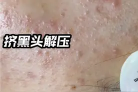 挤黑头！真解压！！视频封面