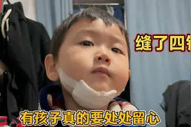 3岁儿子不慎摔伤下巴缝合了四针，看着就疼！宝妈吓得魂都没了！