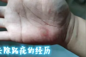经过一个多月时间，总算把这个大的跖疣去除了。视频封面
