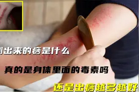 刮痧刮出来的痧是什么？真是身体里面的毒素吗，出痧越多越好吗视频封面