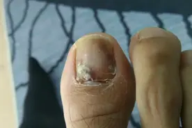 记录指甲被砸以后长出新指甲的过程视频封面