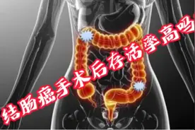 结肠癌手术后存活率高吗？视频封面