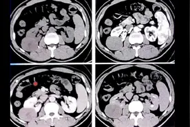 40岁男性，发现右侧肾脏占位，腹部增强CT诊断什么？医生讲解