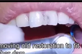 修复门牙视频封面