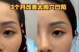 3个动作坚持3个月太阳穴凹陷不见了，人年轻5岁
