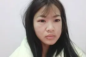 尿毒症女孩大早上起来半边脸都肿了，眼睛好疼，最近运气不太好呀视频封面