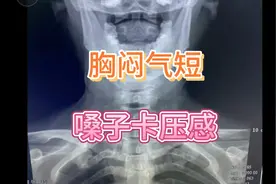 通过X光片分析：胸闷气短和嗓子不舒服的原因！视频封面