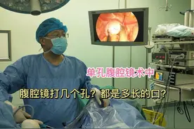 腹腔镜打几个孔?都是多长的口?视频封面