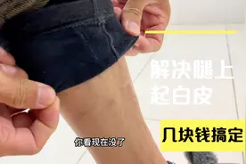 困惑多年腿上起白皮的问题，没想到几块钱解决了，用一次就见效