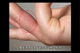 手上长小水泡是什么原因？