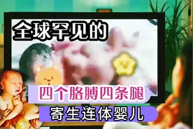 广州孕妇产下了一个寄生连体婴儿，目前寄体宿主已和婴儿手术分离视频封面
