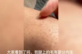 腿毛长成了内生发，长在表皮里了，赶快处理它