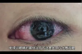电焊闪眼睛的最快治疗方法是什么视频封面