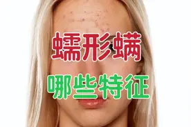 脸上有蠕形螨的人会有哪些特征？重点要看脸部的这4个部位特征！视频封面
