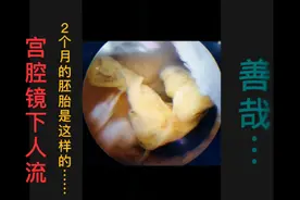 宫腔镜人流2个月的胚胎是这样的……善哉视频封面